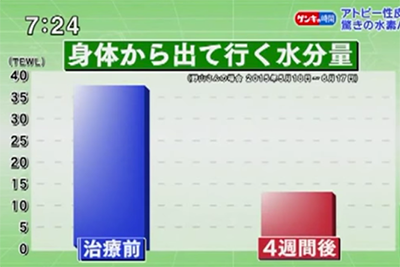 水素風呂は何故アトピーに効果