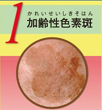 ① 加齢色素斑
