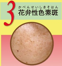 ③ 花弁性色素斑