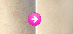 肘、膝 黒ずみ 消す