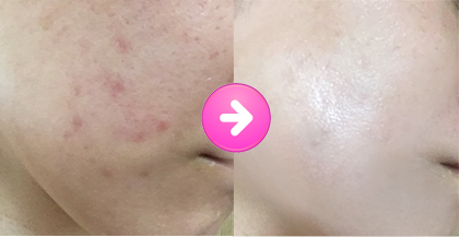 <ニキビ跡が消える>パルクレール美容液って本当に効果あるの?口コミ・成分を徹底検証♪