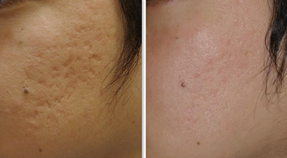 美容液「薬用アクレケア」