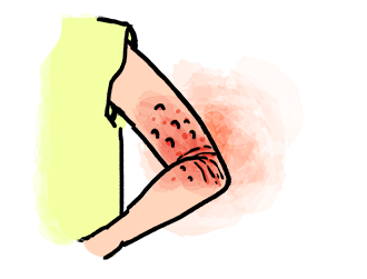 体のかゆみアレルギー体質によく効く漢方薬「澄肌漢方堂」