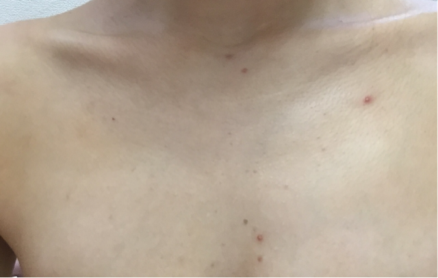 ニキビケア用 ”emione”の化粧水 あいにゃん