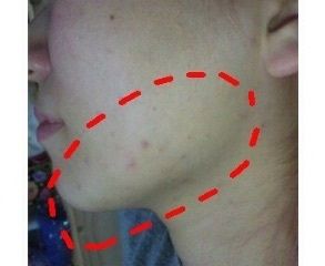 ニキビケア用 ”emione”の化粧水 あいにゃん