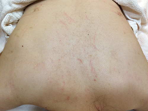 シーズラボの背中ニキビ体験記