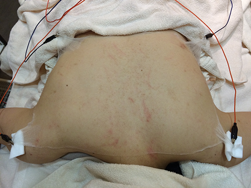 シーズラボの背中ニキビ体験記