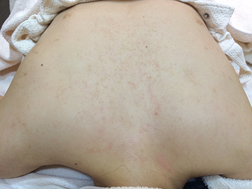 シーズラボの背中ニキビ体験記