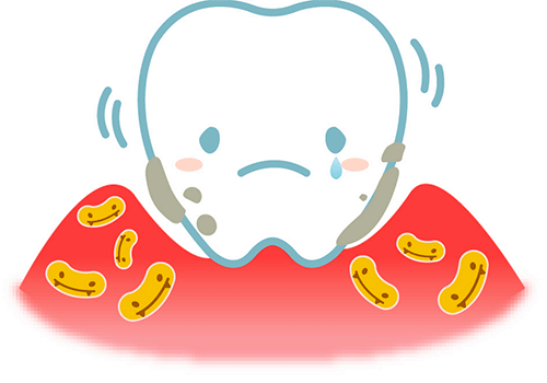 歯周病