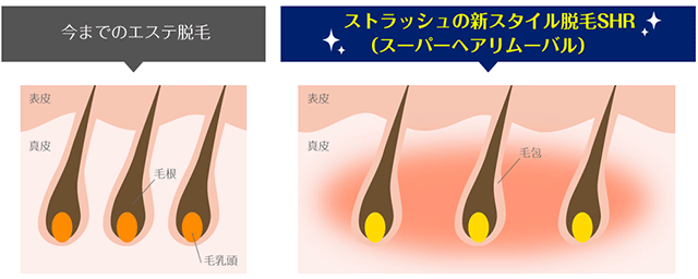 全身脱毛専門店「STLASSH(ストラッシュ)」