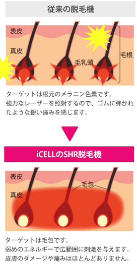 ⅰ)肌に優しい、痛くない脱毛♪