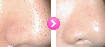 小鼻の毛穴 改善