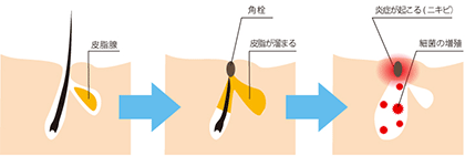 肌荒れ、ニキビの根本を抑える保湿