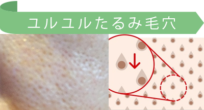 たるみ毛穴 黒ずみ毛穴 たるみ 改善