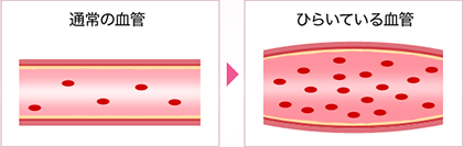 赤ら顔・酒さ 原因