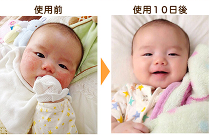 アロベビー ミルクローション 乳児湿疹