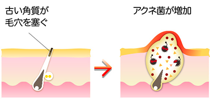 背中のニキビ 皮膚科