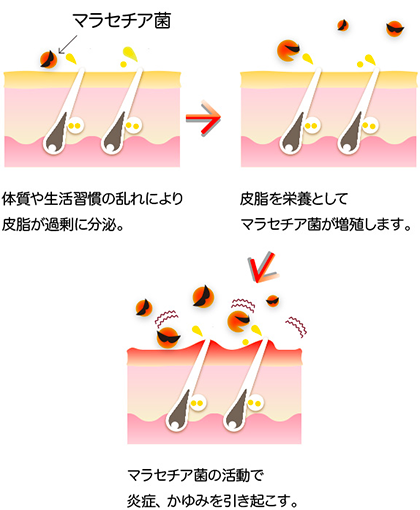 アクネ菌だけでなく、マラセチア菌も繁殖しやすい