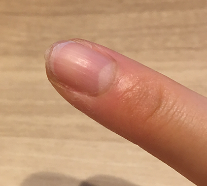 二枚爪 治す方法