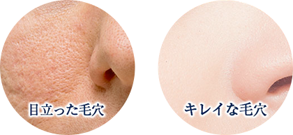 顔の毛孔性苔癬