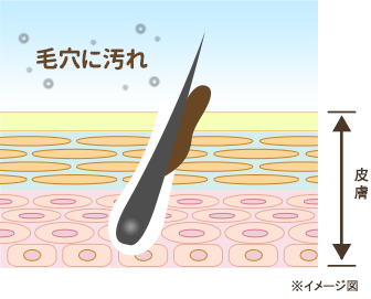 皮脂や汚れで毛穴が詰まっている