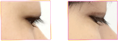 ぱっちりウィンク 口コミ