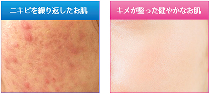 ニキビ